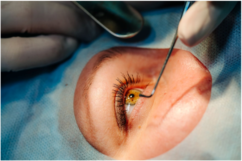 Cirurgia de catarata